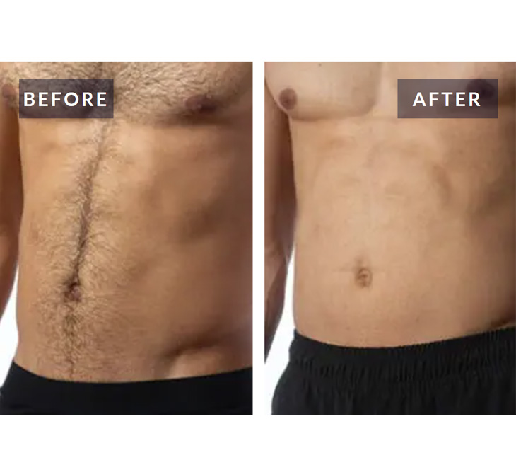 Laser 4K UltraPrime - Sistem complet